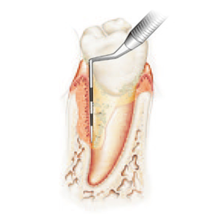 歯周外科手術の手順_1