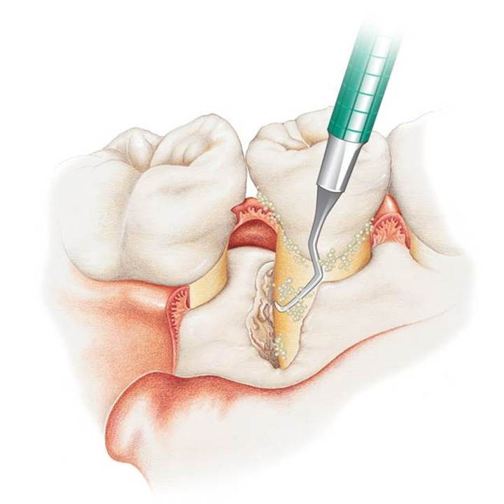 歯周外科手術の手順_3